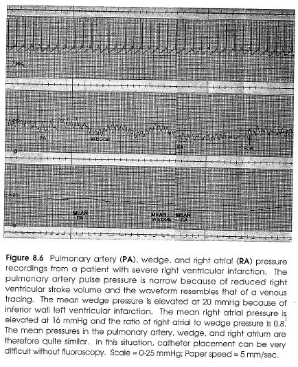Right Ventricular Infarction Pulmonary Artery Pressure and Cardiac Output PA pressure is commonly elevated and parallels the increased wedge pressure.