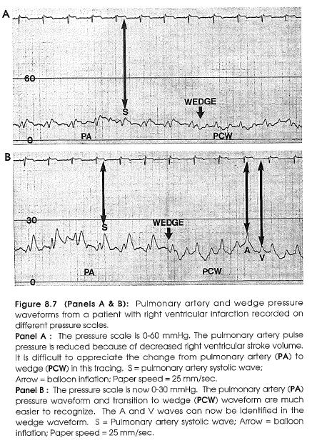Right Ventricular Infarction This can make bedside catheter placement
