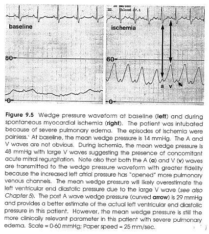 Acute Left Ventricular Ischemia Wedge pressure and pulmonary artery pressure Capillary muscle ischemia can cause a profound increase in the mean wedge pressure