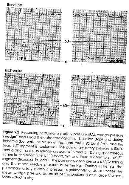 Acute Left Ventricular Ischemia The increase in the wedge pressure is transmitted to the pulmonary circulation causing an increase in the pulmonary artery systolic and diastolic pressures.