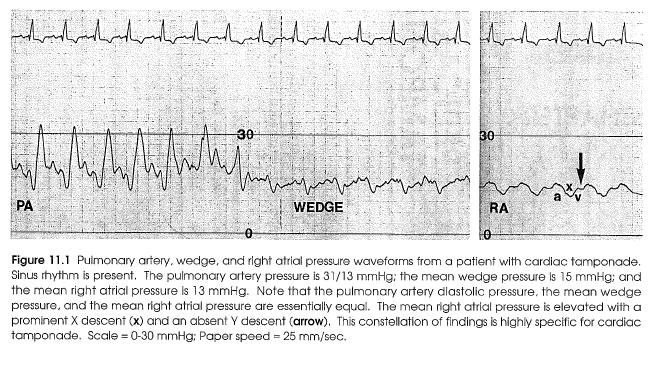 Pericardial Tamponade-RA, PAOP, PAP Mean RA pressure is elevated ~ 10-15 mm Hg.