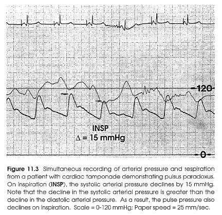 Pericardial Tamponade-Aortic Pressure Alfred Kussmaul is responsible for describing pulsus paradoxus in patients with pericardial tamponade.