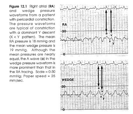 Pericardial Constriction-Intracardiac Pressures RA and Wedge pressures are elevated; the magnitude of the atrial pressure elevation is determined by the degree of constriction.