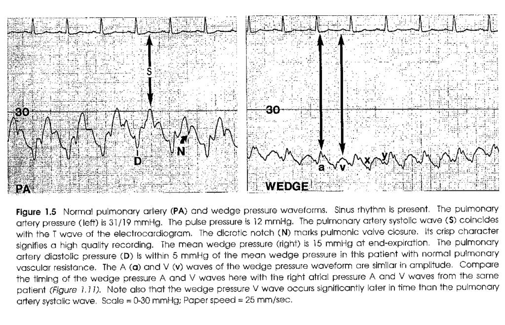 Pulmonary Artery Pressure The peak of the pulmonary artery systolic pressure wave occurs within the electrocardiographic