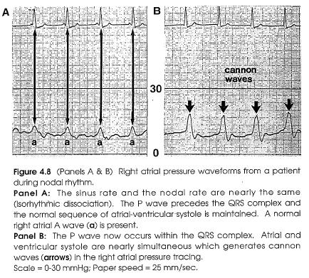 AV Junctional (Nodal) Rhythm During a nodal rhythm, atrial systole can either precede or follow ventricular systole.