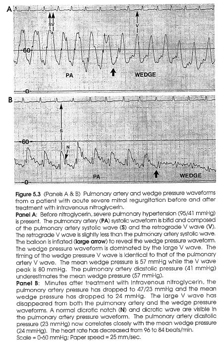 General comments on the V wave The degree of mitral regurgitation is sensitive to left ventricular afterload.