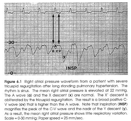 Tricuspid Regurgitation R Atrial Pressure The X descent is therefore attenuated or obliterated.