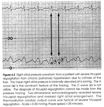 Tricuspid Regurgitation R Atrial Pressure The right atrial pressure waveform of tricuspid regurgitation will be modified by the size and dispensability of the right atrium.
