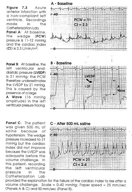 Acute Left Ventricular Infarction In patients with a very noncompliant infarction (and a very large A wave), the optimal mean wedge pressure may be below 15 mm Hg.