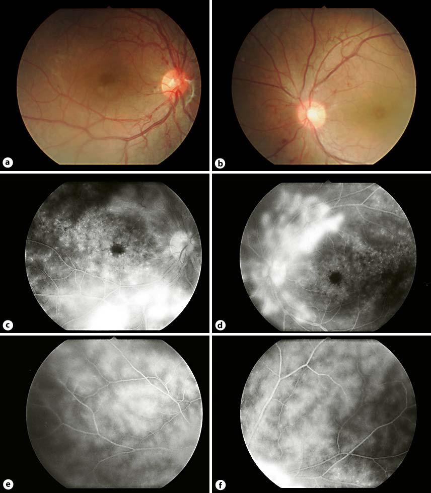 158 Fig. 1. Fundus photography and fluorescein angiogram on initial examination.