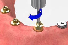 Note: The X-ray tube must be positioned perpendicular to the implant prosthetic platform. Tighten each OD Secure abutment to 30 Ncm using a calibrated torque wrench and an.050 (1.25mm) hex driver.
