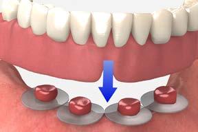 Place a small amount of a material of choice into the recessed area of the denture and around the denture caps. 7 Seat the denture Insert the denture.