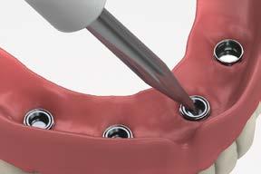 It is best to hold the denture with the occlusal side down and snap the retention insert into the metal cap.