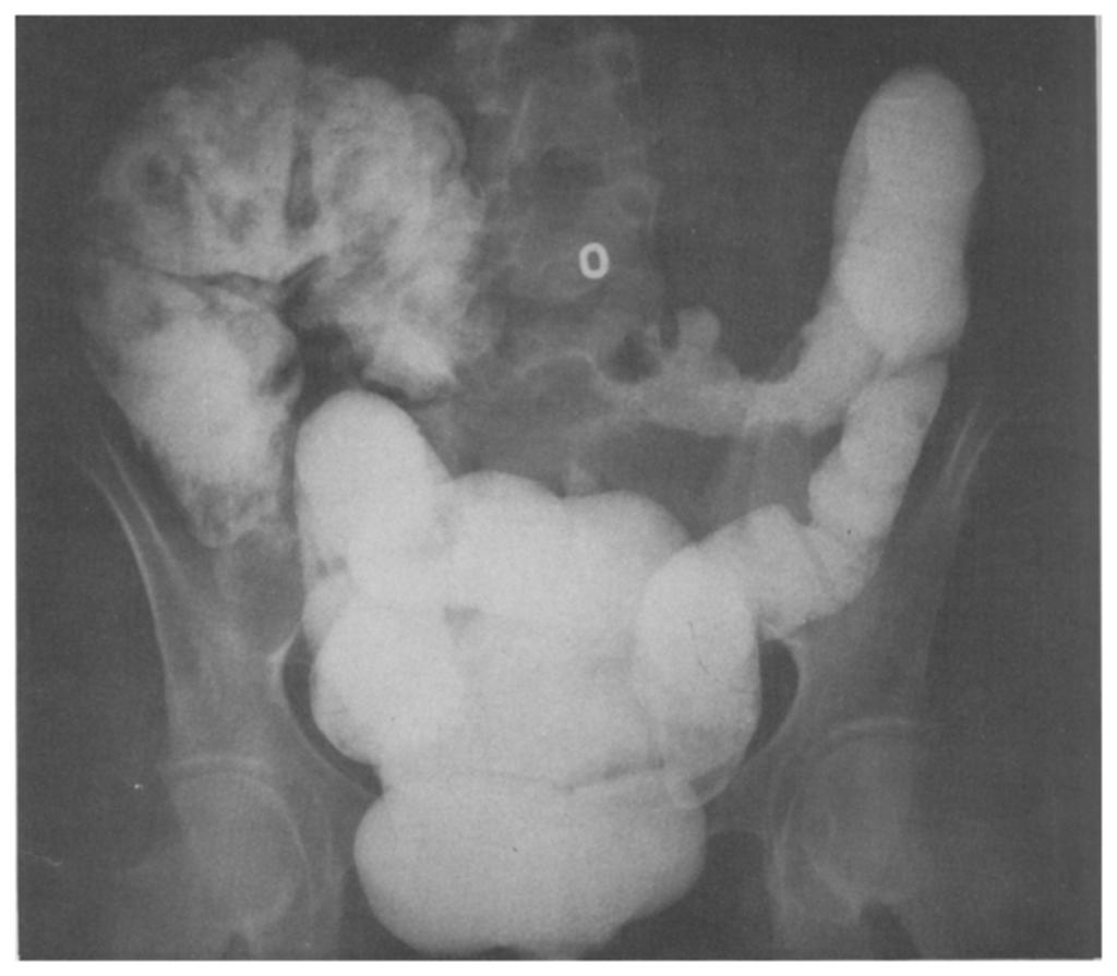 Six months prior to admission the patient had experienced persistent lower abdominal pain, diarrhea, and a 25-lb weight loss despite a daily maintenance dose of 40 mg of prednisone.