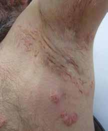 Patient with Hurley stage II hidradenitis suppurativa after treatment with biologic therapy, showing extensive involvement of the back with inflammatory nodules and scarring.