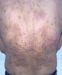 Episodes of nodules may recur in the same location or general area. Early symptoms of HS include pain, pruritus, heat and hyperhidrosis.