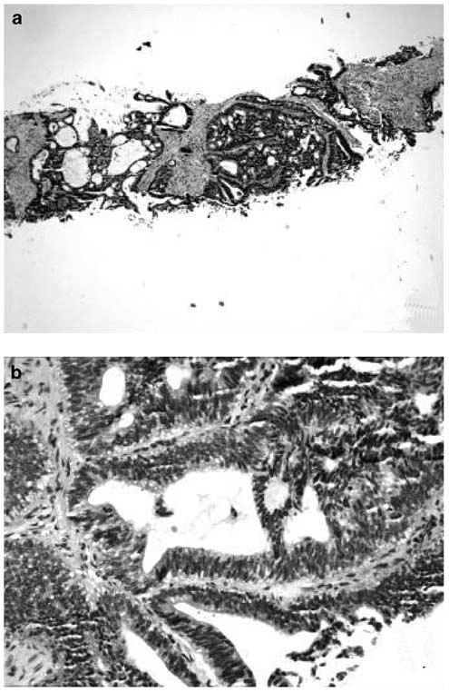 Urothelial-type adenocarcinoma of prostate 589 Figure 3 Microscopic features of mucin-producing urothelialtype adenocarcinoma of the prostate as it appeared in a needle core biopsy in case #2 (H&E