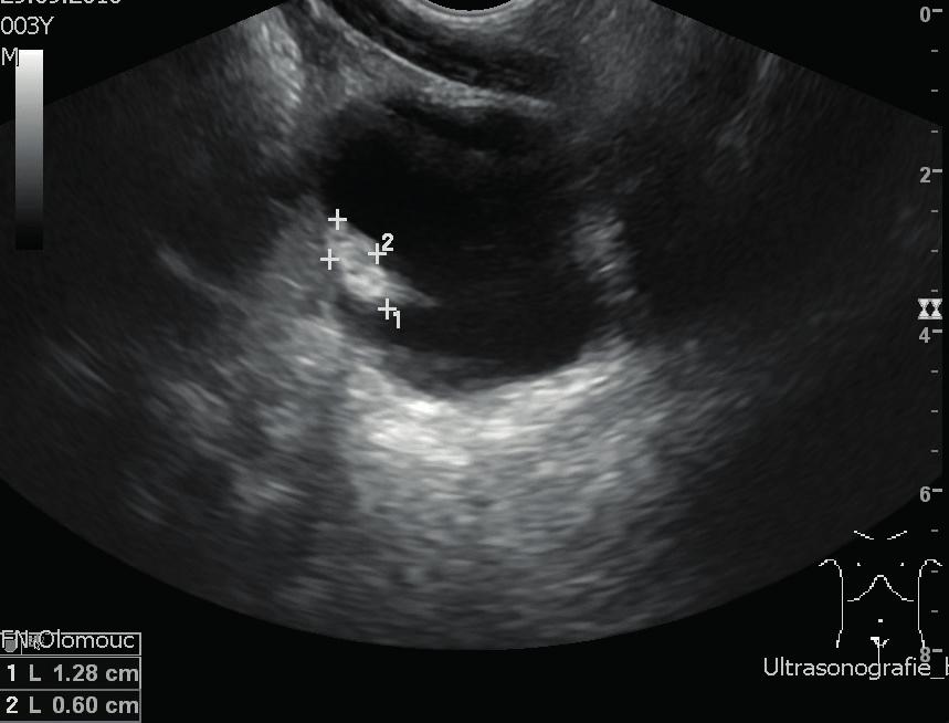 Biomed Pap Med Fac Univ Palacky Olomouc Czech Repub. 2016 Dec; 160(4):578-582. Fig. 1. Transabdominal sonography - sagital view, urinary bladder with tumour. Fig. 2. Transabdominal sonography - sagital view, urinary bladder with tumour with color-flow mapping.