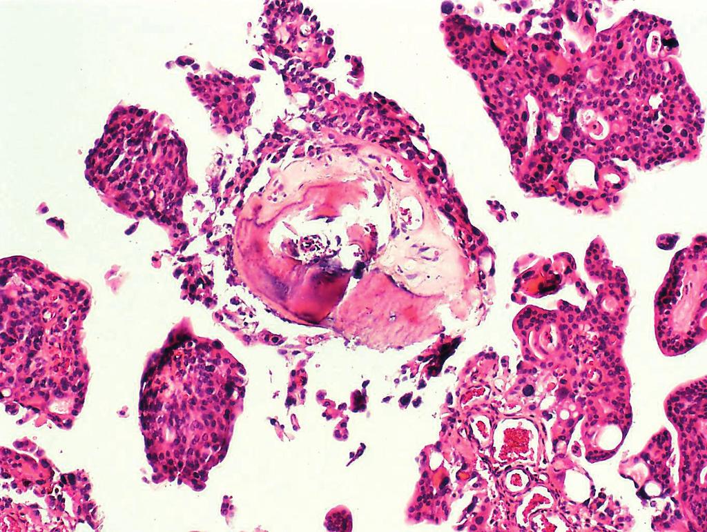 Fig. 5. Microscopy - bone metaplasia in stromal papillae (H&E 200x). importance with subsequent histological confirmation of the tumor by biopsy or TUR.
