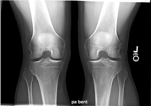 Radiographs: 2 keys to ordering knee xrays 1.