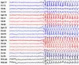 Abnormal EEG and recurrence risk Recurrence risk All studies in children indicate increased recurrence risk Most studies in adults indicate increased risk