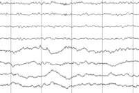 persists even after controlling for other variables Important considerations Utility of abnormal EEG is higher in non-remote symptomatic cases EEGs should