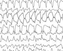may be higher Duration of initial seizure If first seizure was prolonged