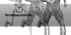 BM and WHAM Weak hip adductor muscles (WHAM) Decreased hip