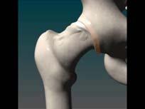Impacts into acetabulum Young active male FAI Labral