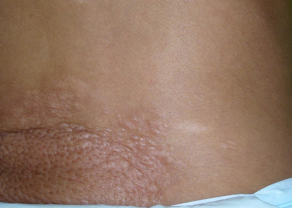 Shagreen patch (Tuber Sclerosis)