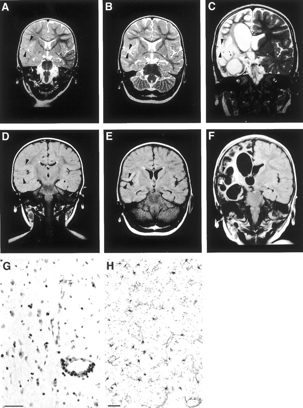 Figure 2. Serial MRI and histopathologic findings of a girl with onset of the disease at 1.