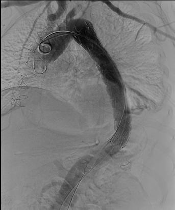 Long-term experience with endovascular therapy The stent graft is usually introduced via the femoral artery into the affected site of the aorta.