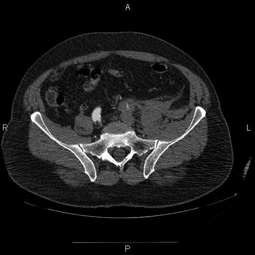 Pre-operative CT shows the extent of dissection