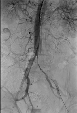 Endovascular therapy consists of the thoracic