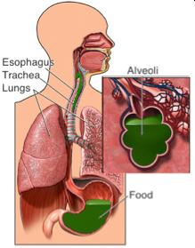 aspiration Lower esophageal sphincter GERD 38 GERD and Asthma: