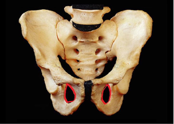 It is a large gap in the hip bone lying anteroinferior to