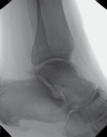 This view is optimal for view of the plantar aspect of the calcaneus and tarsals.