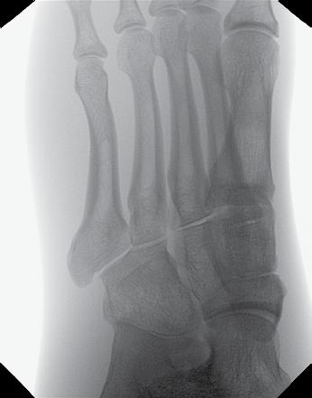 Medial aspect of foot is placed flat on the detector.