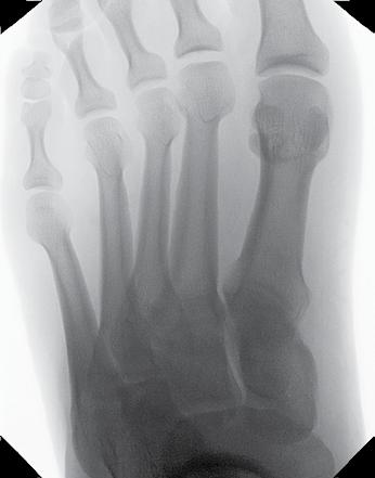 Plantar surface of foot is laid flat on detector.
