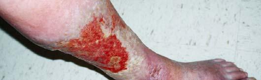 medial malleolus Appearance: Wound depth