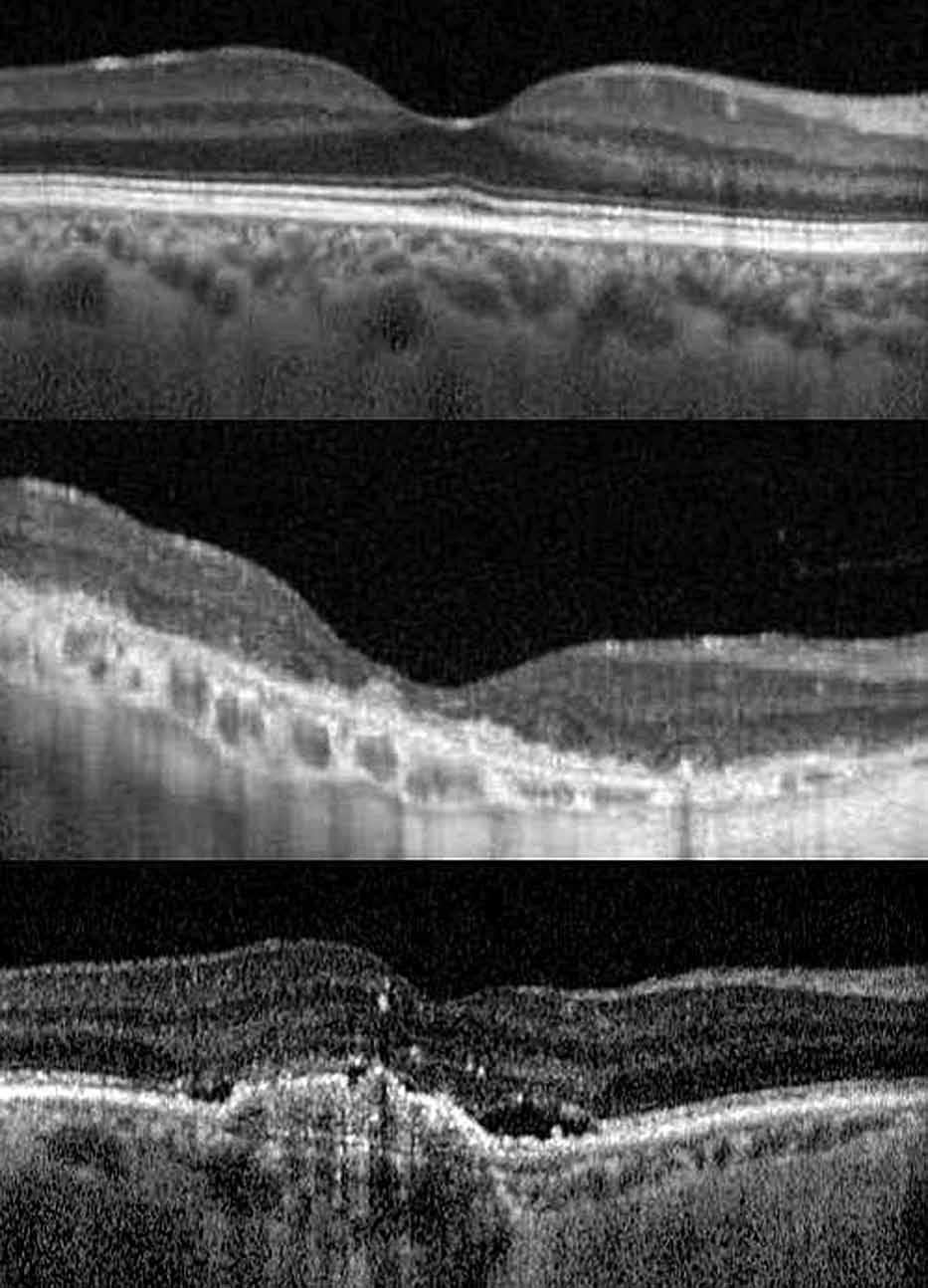 Figure 1. Enhanced depth imaging optical coherence tomography scans in a normal eye (upper image), dry type age-related macular degeneration (AMD) (middle image), and wet AMD (lower image).