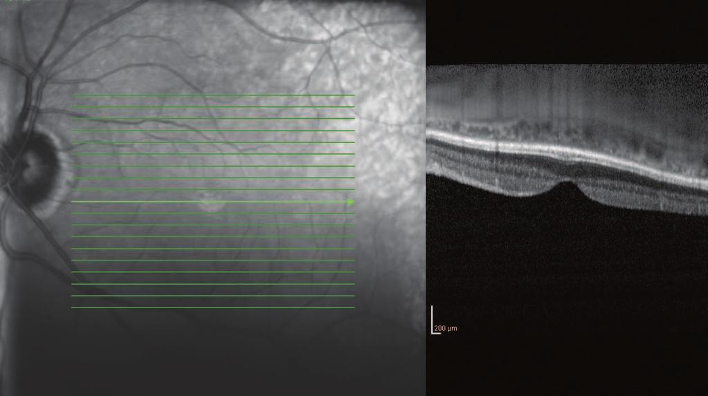 To obtain the choroidal image, we positioned the combined Heidelberg Spectralis device (Spectralis HRA+OCT, Heidelberg Engineering, Heidelberg, Germany) sufficiently close to the eye, obtaining an