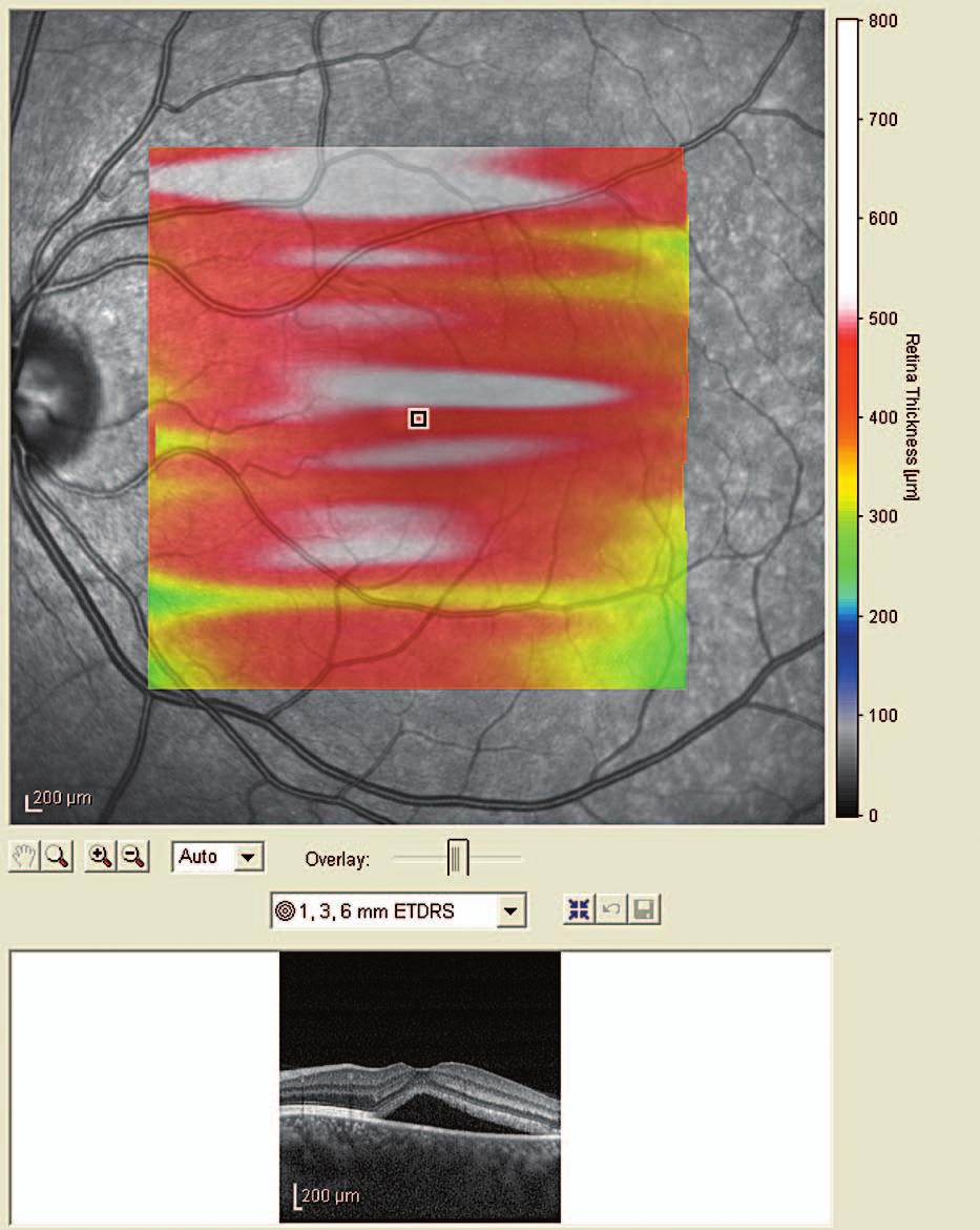 3.45 mm zone in the macula after manual segmentation of choroidal thickness. Figure 4.