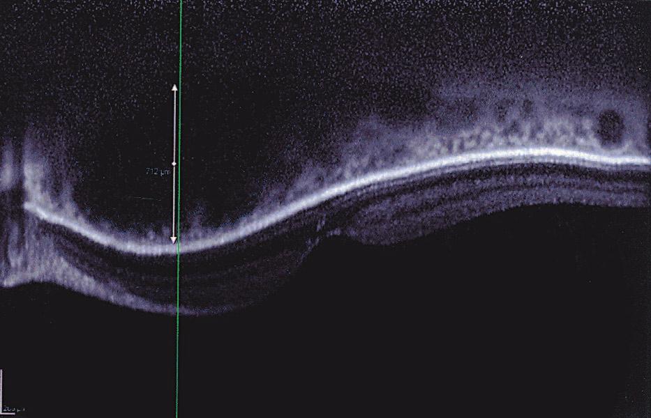 image). One month after photodynamic therapy, thickness at the same point decreased to 273 µm (lower image). Used with permission from the Iranian Journal of Ophthalmology.