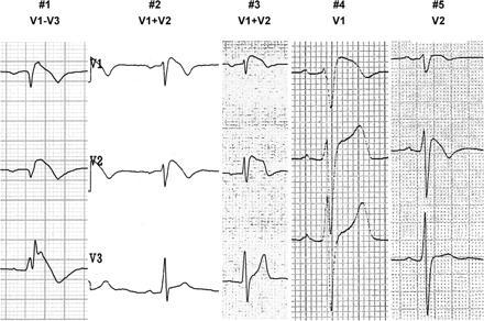 Variation of ECG Pattern in Brugada