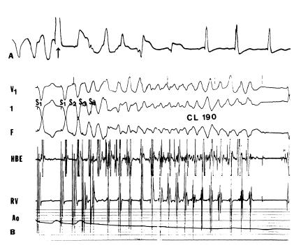 Long QT Syndrome 15 pts with LQTS with syncope or cardiac arrest Neither the inducibility of non-sustained VT nor the results of drug testing with beta- blockers proved to be of any