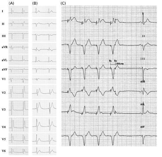 Short QT Syndrome 18 pts with SQTS presented with syncope/scd or Dx during family screening underwent EPS mean vent ERP 155ms (CL 500-600ms) and 150ms (CL 400-430), and inducible VF in 11/18 (61%).