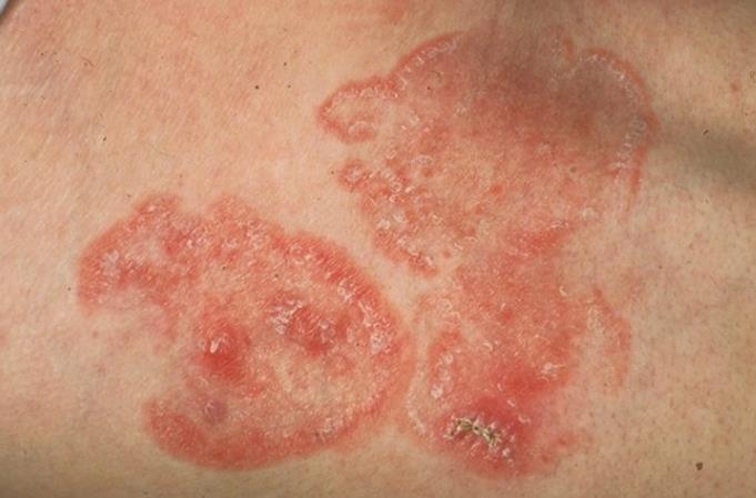 Cutaneous lymphoma Lymphoma in the skin Usually T cell, but can be B cell Most common subtype: mycosis fungoides Most common in those aged 50+, but can occur in younger