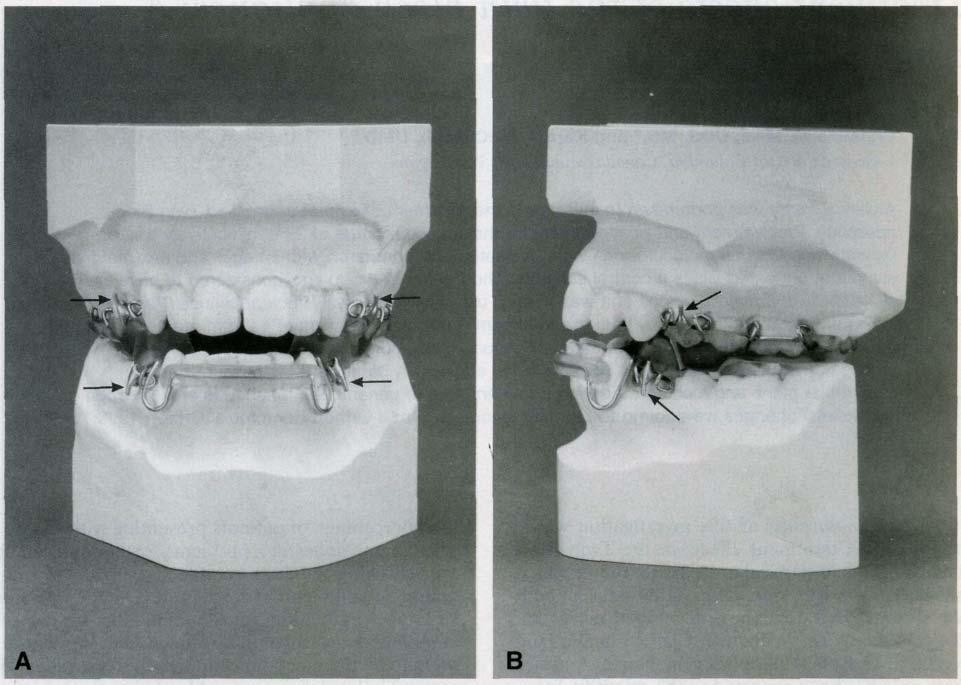 16 Mills and McCulloch American Journal of Orthodontics and Dcntofacial Orthopedics July 1998 Fig. 1 A, B.