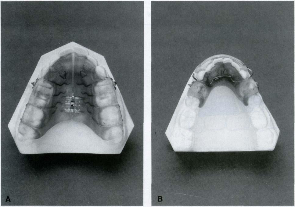 American Journal of Orthodontics and Dentofacial Orthopedics Volume 114, Wo. 1 Mills and McCulloch 17 Fig. 2 A, B.